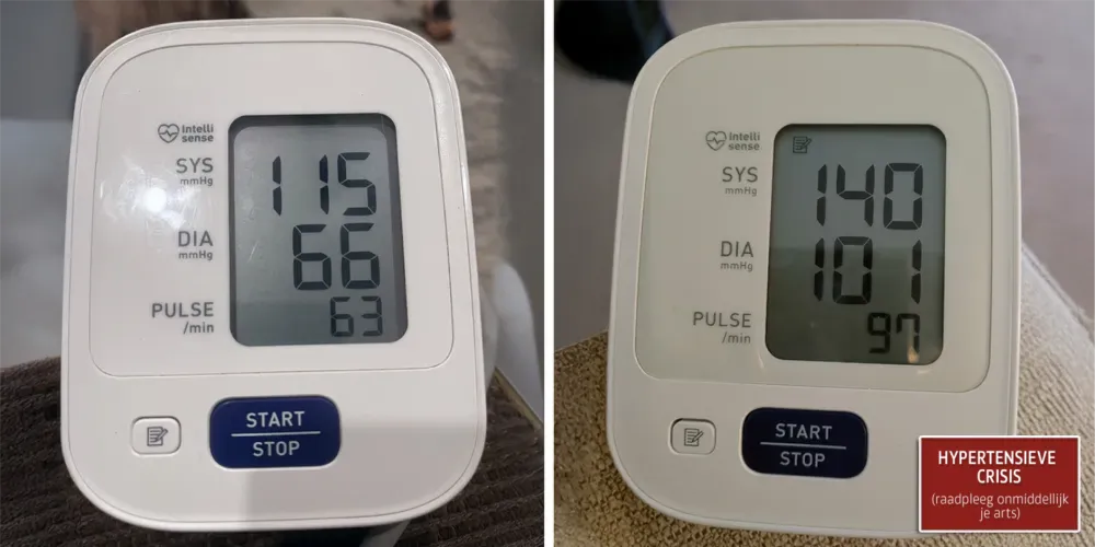 Derila sleep apnea 2 hypertensive crisis C SM NL